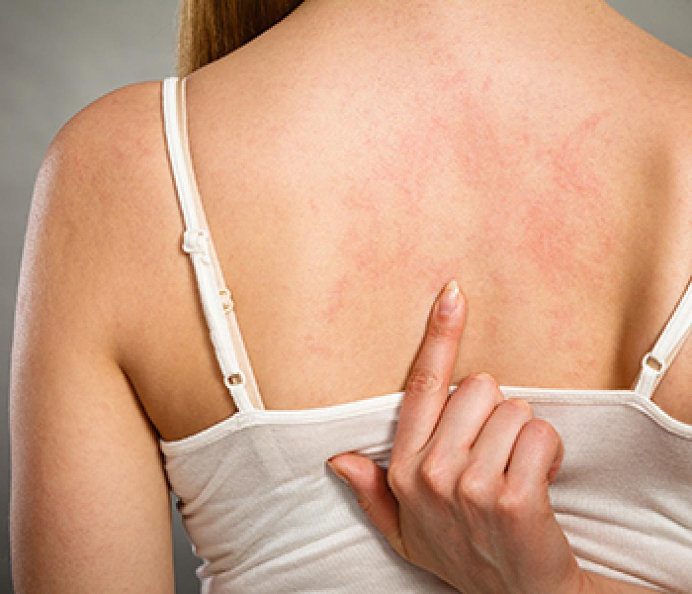 джиа мари каранджи последняя фотосессия. основные клинические проявления спид. первые признаки вич у женщин. первая женщина спид. вич симптомы у женщин первые.